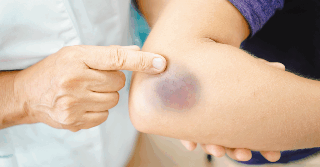 A hand points to a bruise on someone's arm.